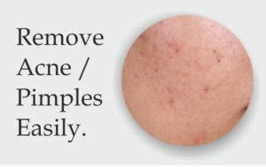 how to remove acne